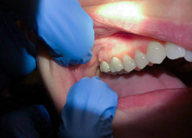 Best Emergency Root Canal Treatment in South Henderson, NC