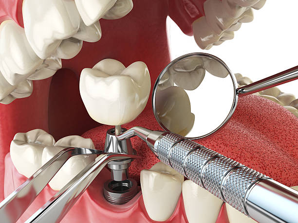 Best Emergency Root Canal Treatment in South Henderson, NC